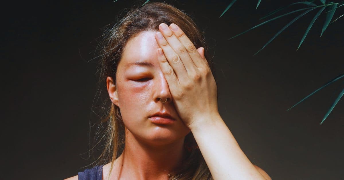 Some people are very allergic to bee stings